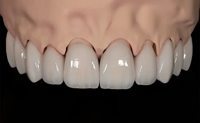 Fațete Dentare cu Aspect Natural