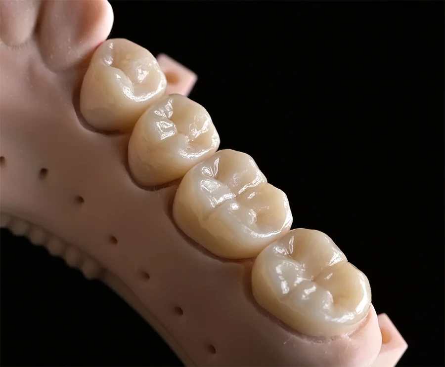 Coroane Dentare cu Aspect Natural