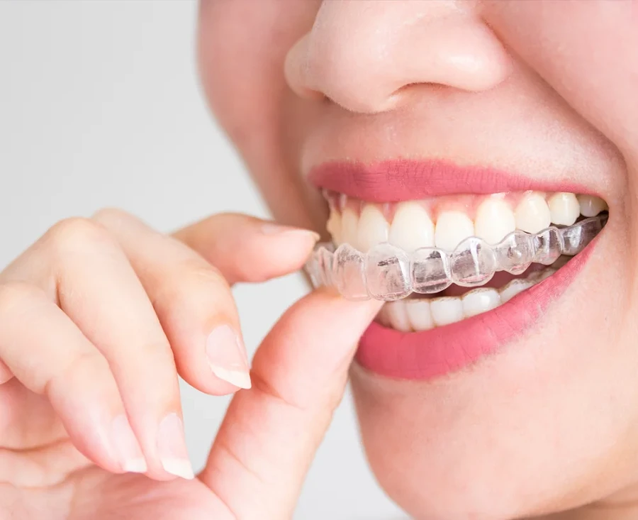 Aparat invizibil tip gutiere transparente