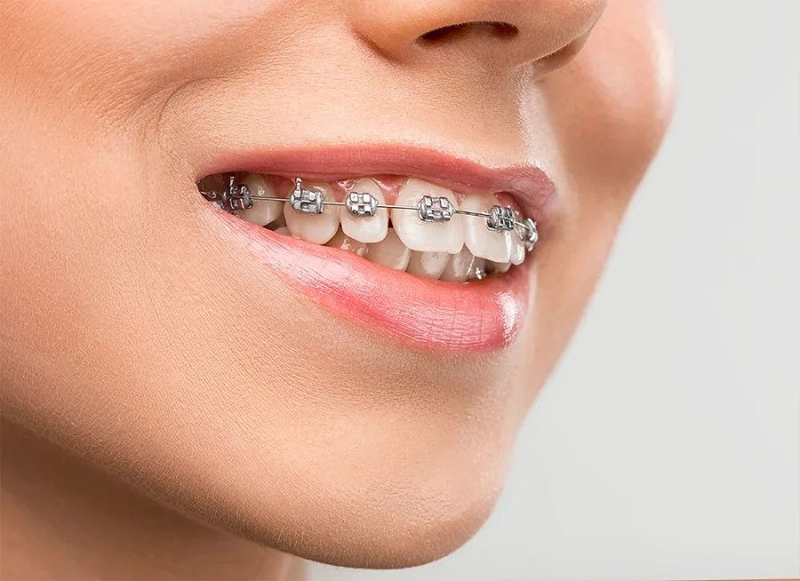 Tratamentul ortodontic (Aparat dentar)