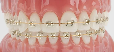 Aparat Dentar Iconix®