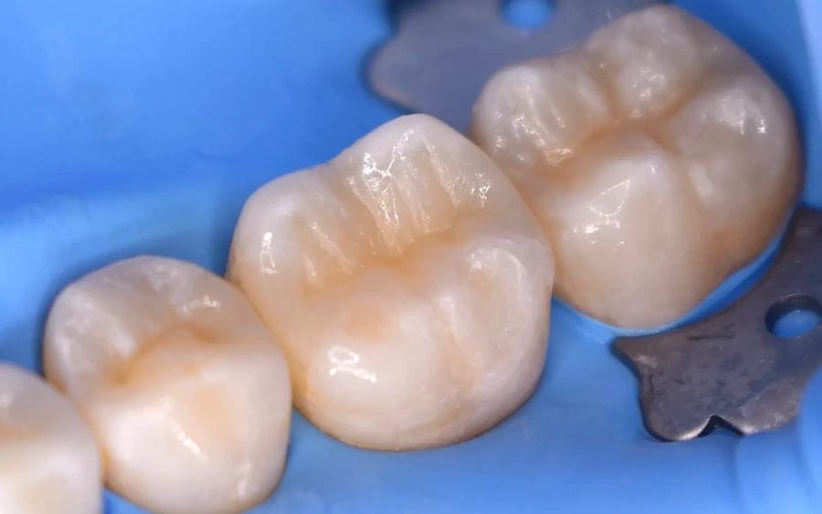 Obturații Dentare cu Aspect Natural – Tipuri, Beneficii și Îngrijire