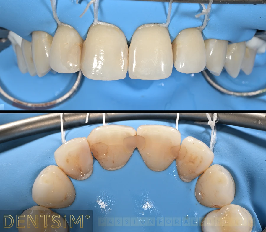 Când este necesar să schimb vechile obturații dentare?