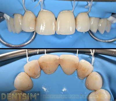 Când este necesar să schimb vechile obturații dentare?