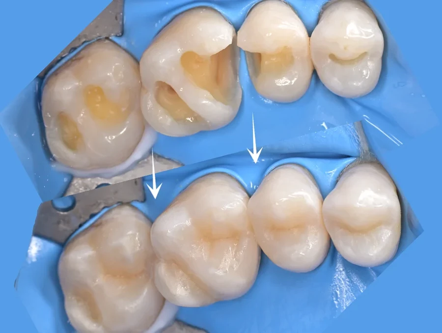 Obturații Dentare: Răspunsuri la cele mai frecvente întrebări