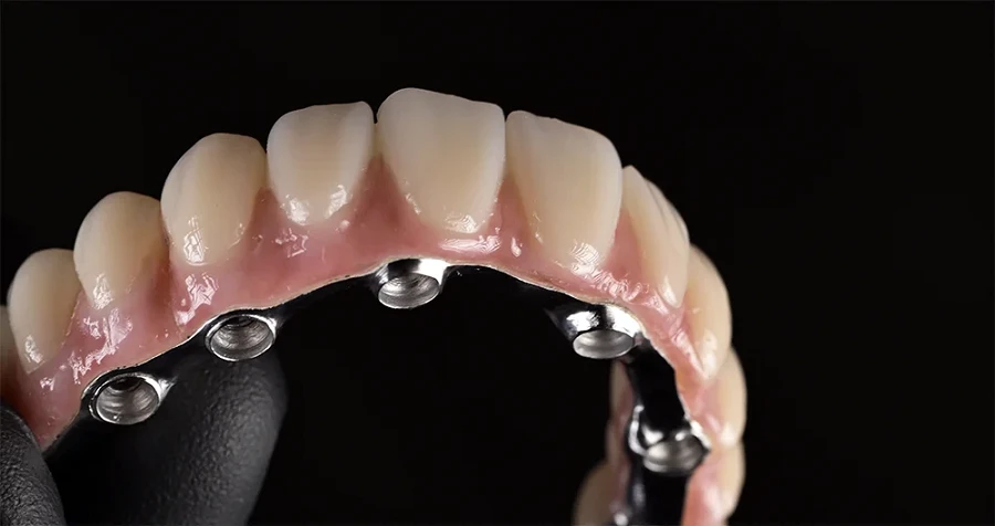 Tot ce trebuie să știi despre All-on-4 și All-on-6