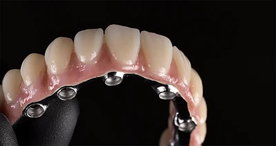 Tot ce trebuie să știi despre All-on-4 și All-on-6