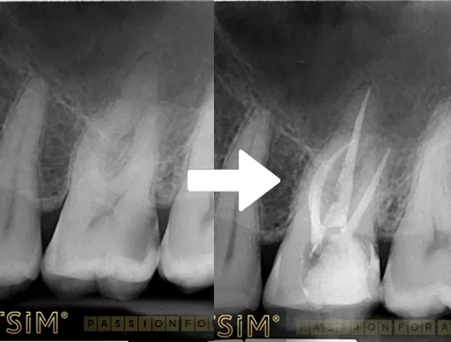 Tratamentul Endodontic