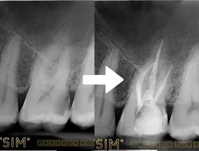 Tratamentul Endodontic