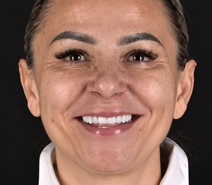 Rezultatul reabilitării complete cu fațete dentare integral ceramice