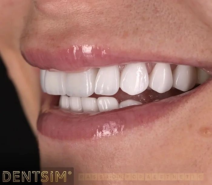 Rezultatul final al reabilitării dentare
