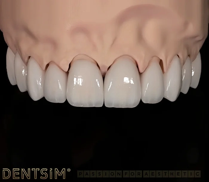Detaliu al rezultatului cu fațete dentare